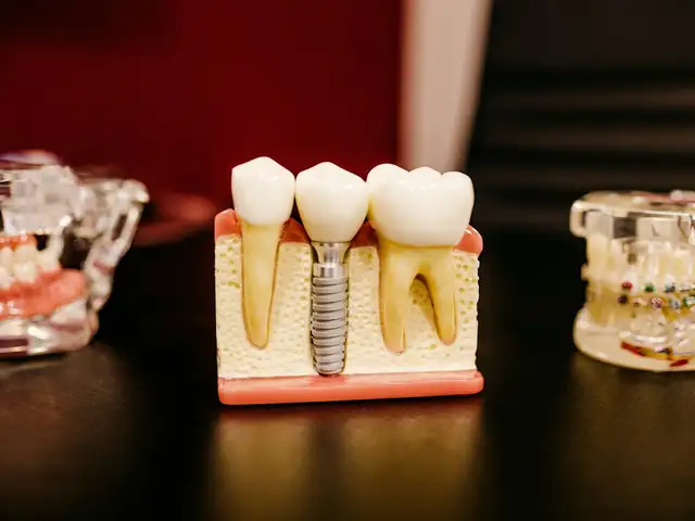 Implant Gigi (per unit)