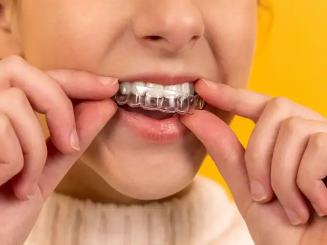 Invisalign Full