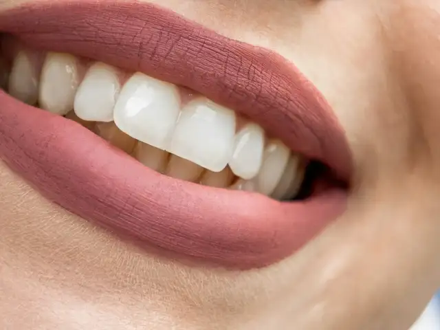 In-Office Whitening