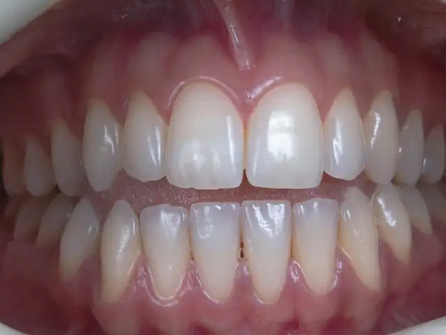 Invisalign Lite