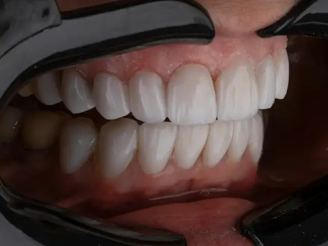 Composite Veneer (per gigi)