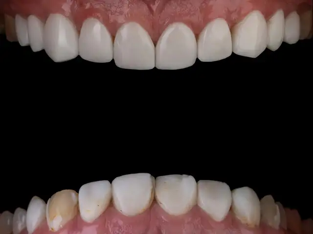 Home Whitening Kit